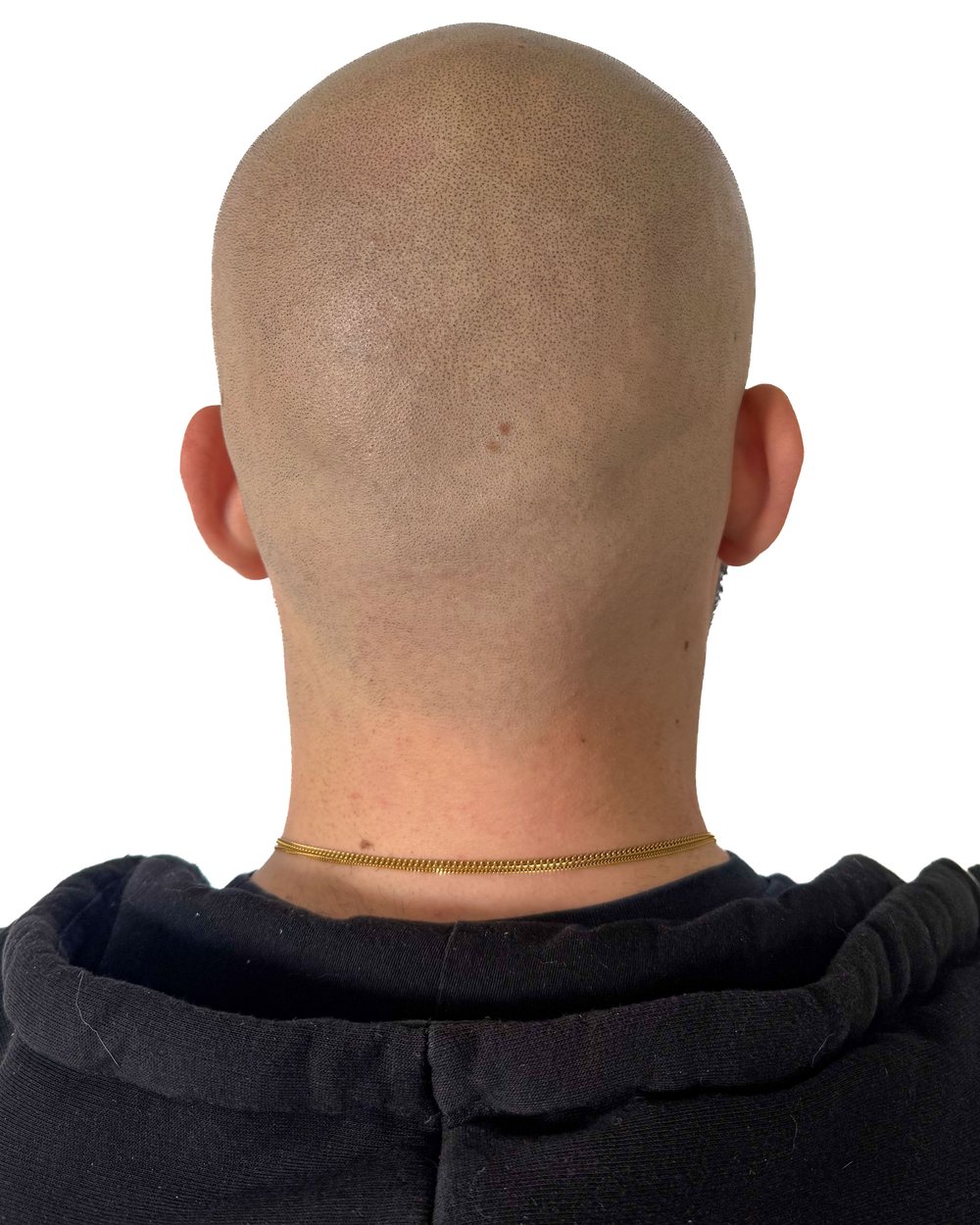 Résultat effet rasé après micropigmentation du cuir chevelu sur une calvitie, vue de l'arrière