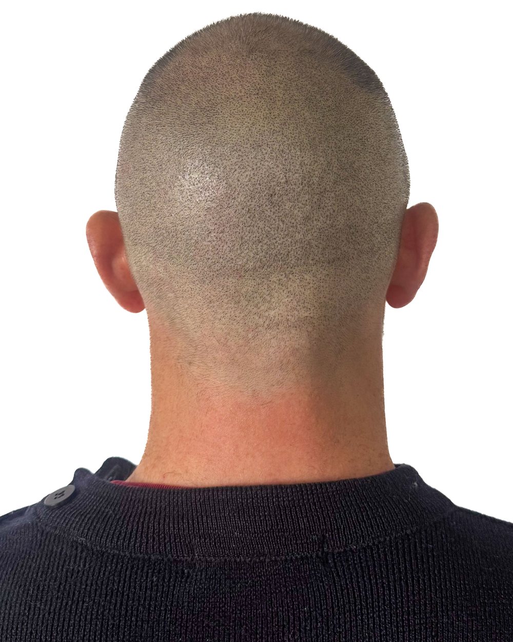 Après micropigmentation, cicatrices, cas 1