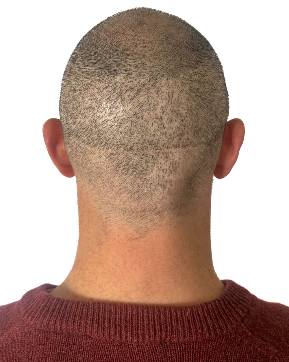 Avant micropigmentation, cicatrices, cas 1