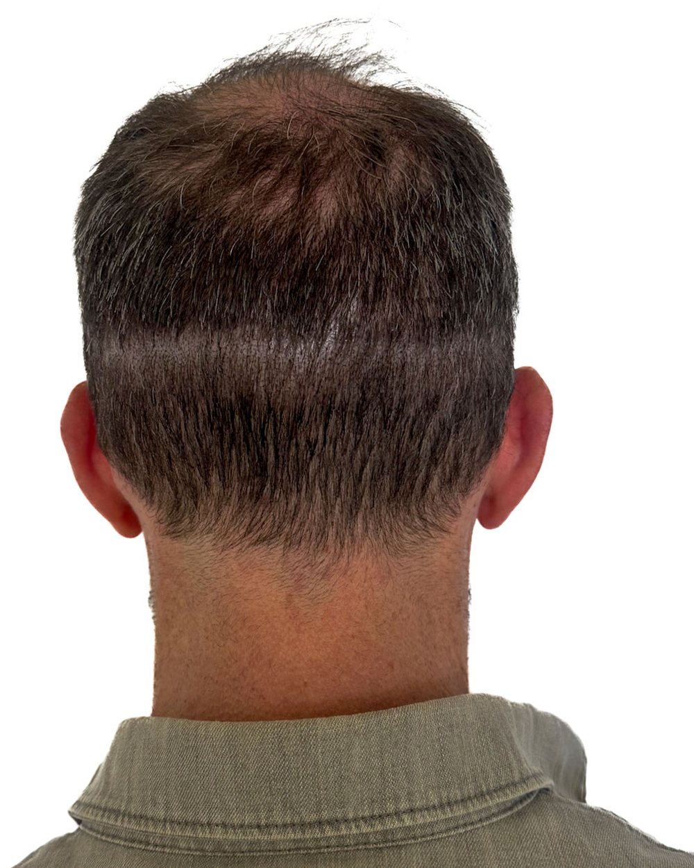 Après micropigmentation, cicatrices, cas 2
