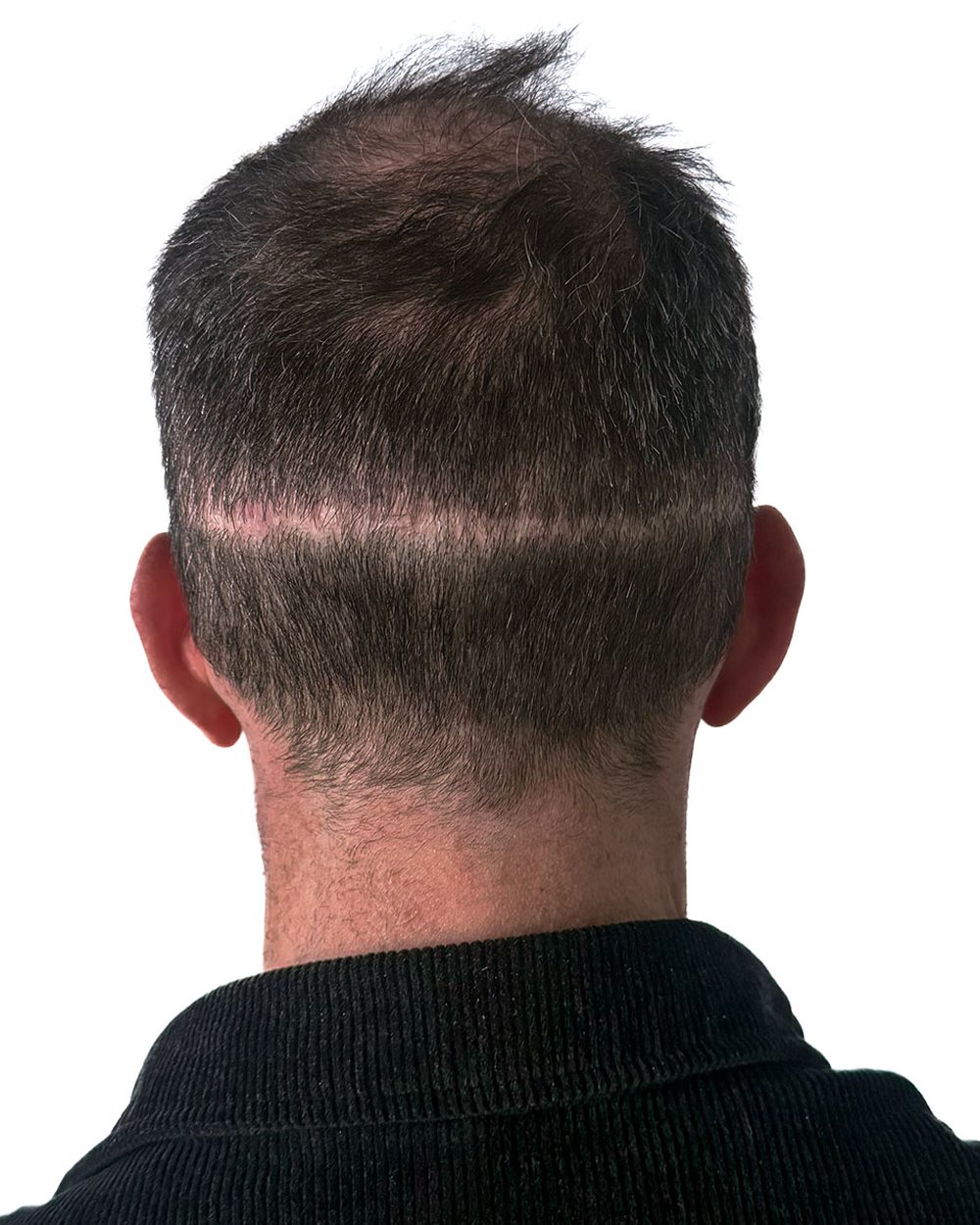 Avant micropigmentation, cicatrices, cas 2