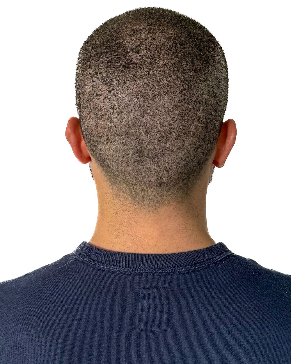 Après micropigmentation, cicatrices, cas 3