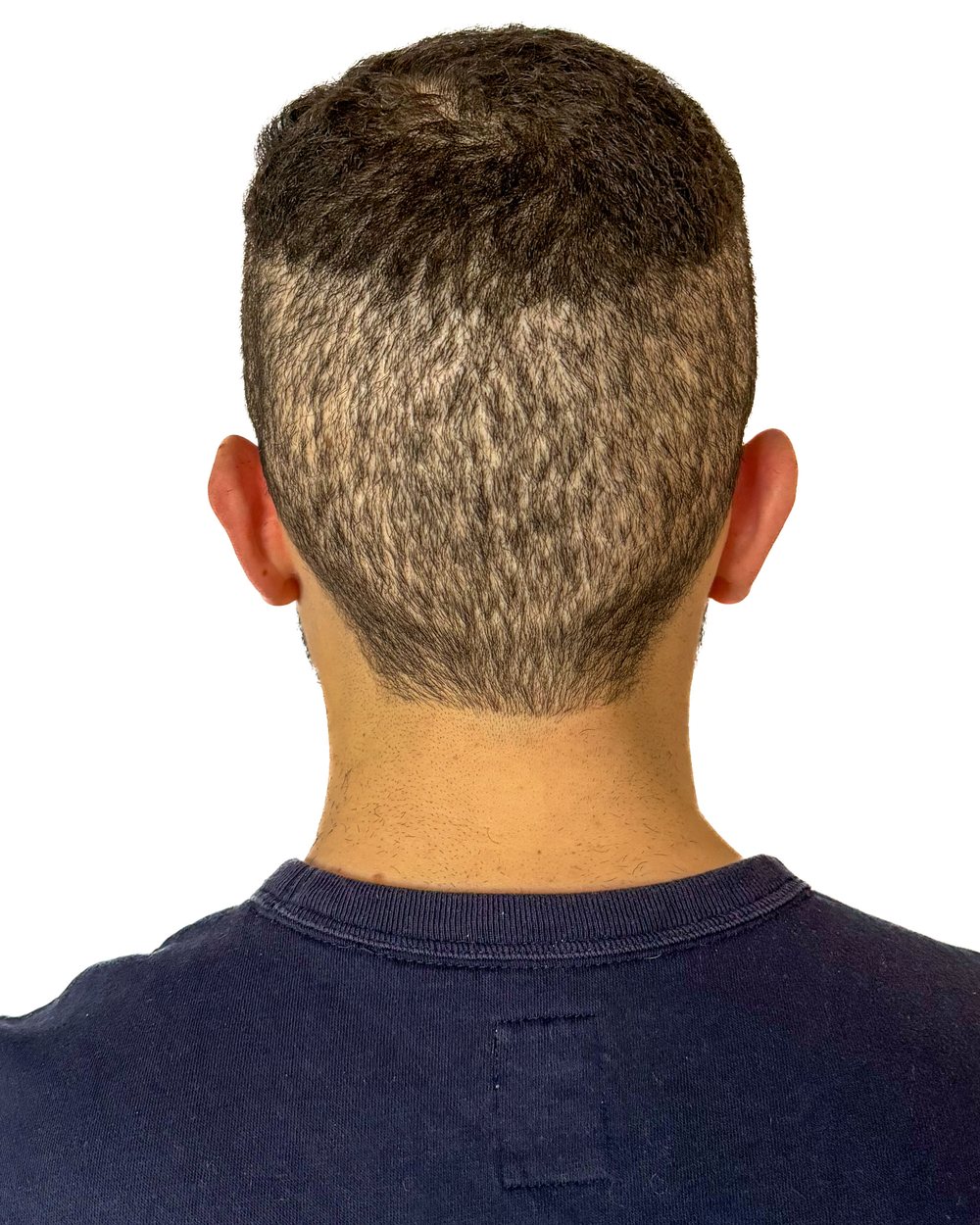 Avant micropigmentation, cicatrices, cas 3
