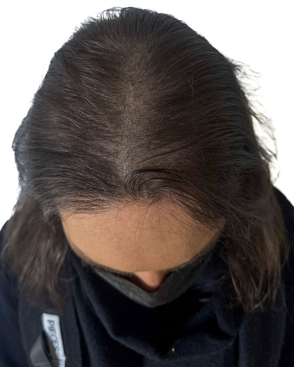 Après micropigmentation, densité, femme, cas 1