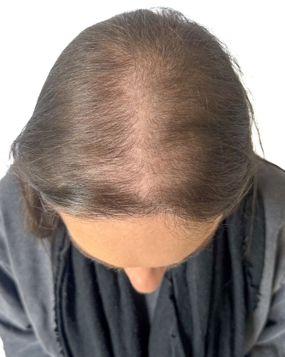 Avant micropigmentation, densité, femme, cas 1