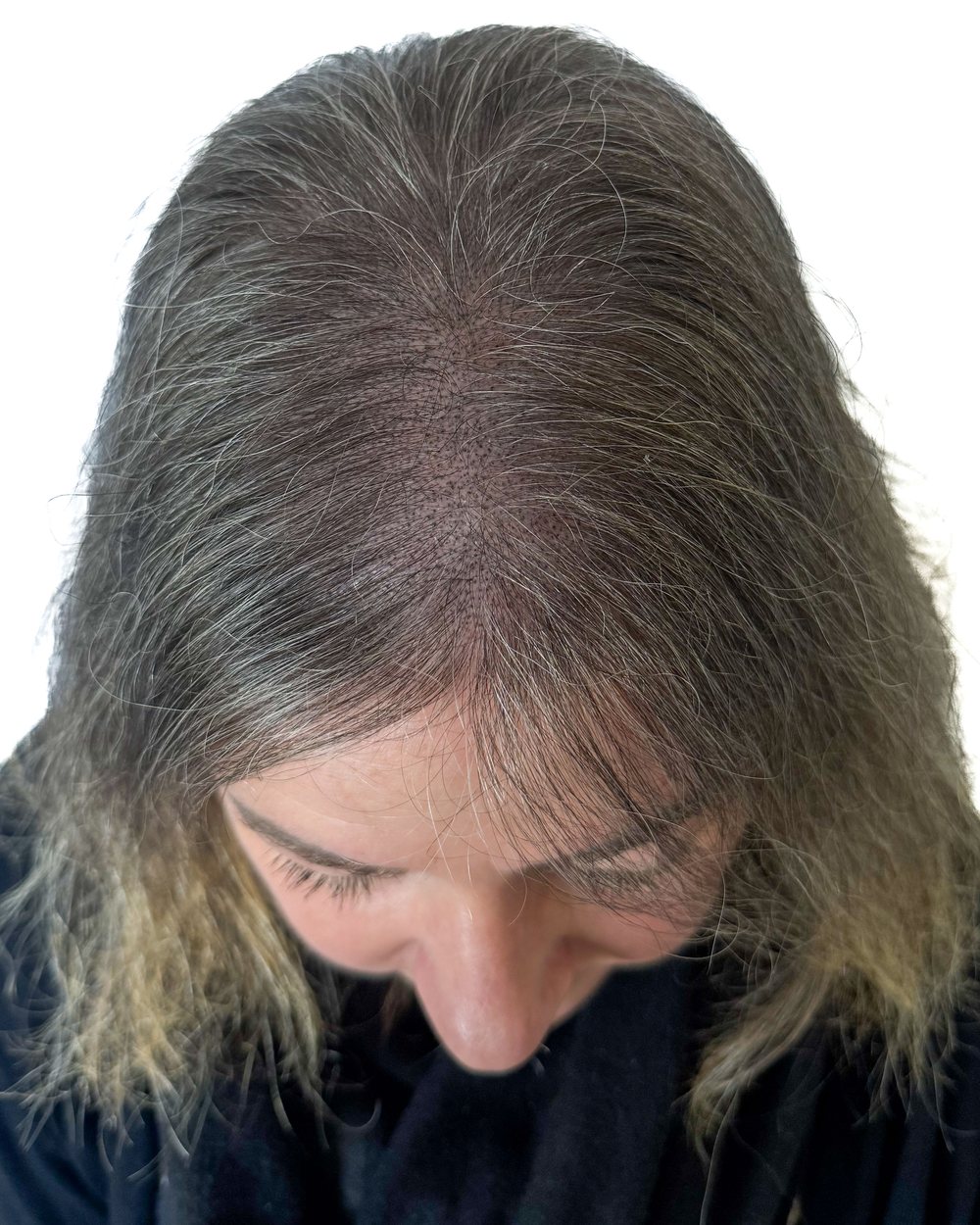 Après micropigmentation, densité, femme, cas 2