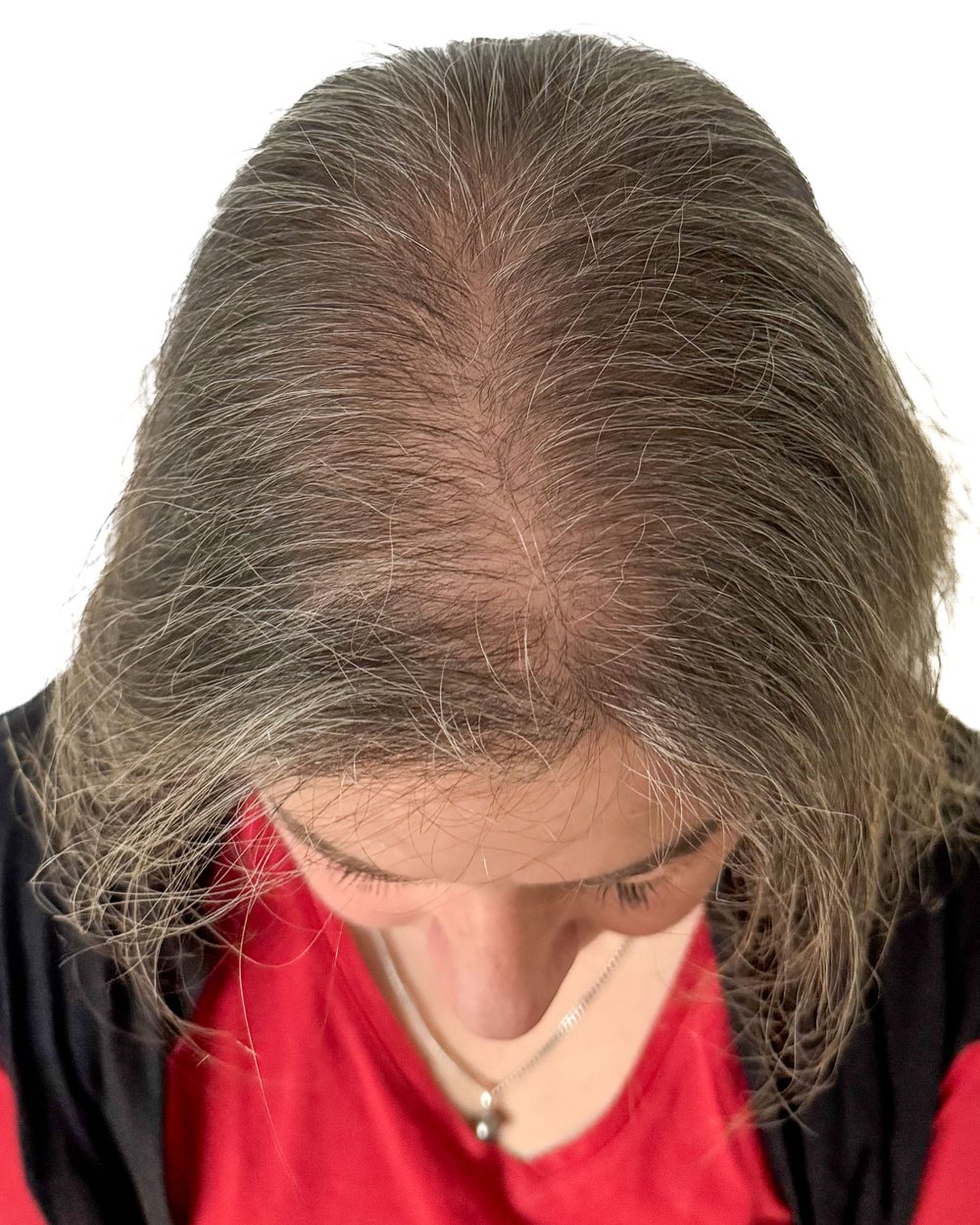 Avant micropigmentation, densité, femme, cas 2