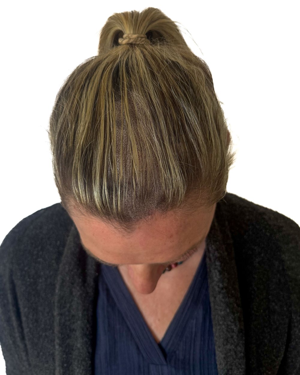 Après micropigmentation, densité, femme, cas 3