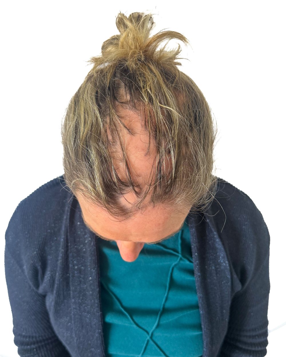 Avant micropigmentation, densité, femme, cas 3