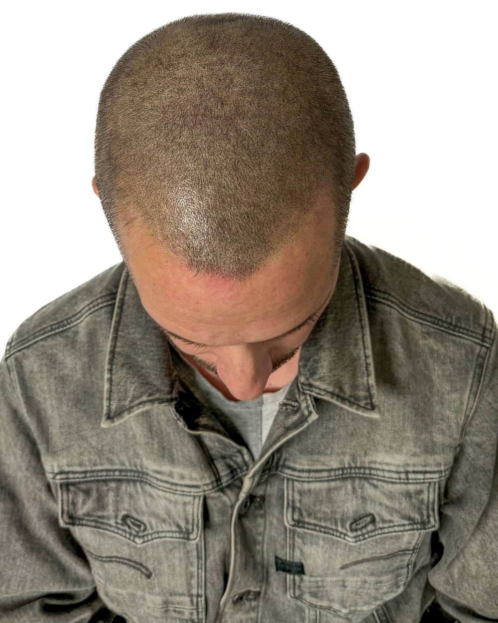 Après micropigmentation, densité, homme, cas 1