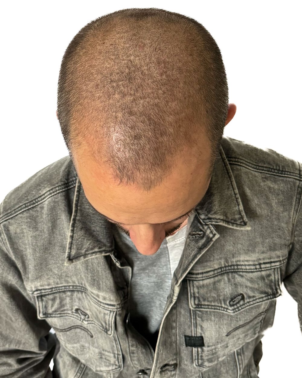 Avant micropigmentation, densité, homme, cas 1