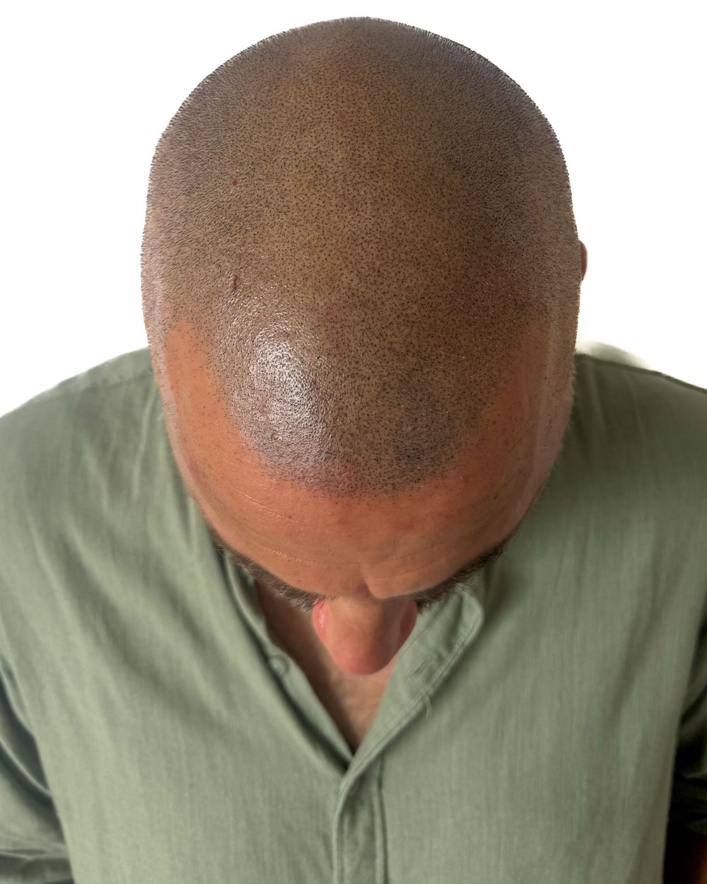 Après micropigmentation, densité, homme, cas 2