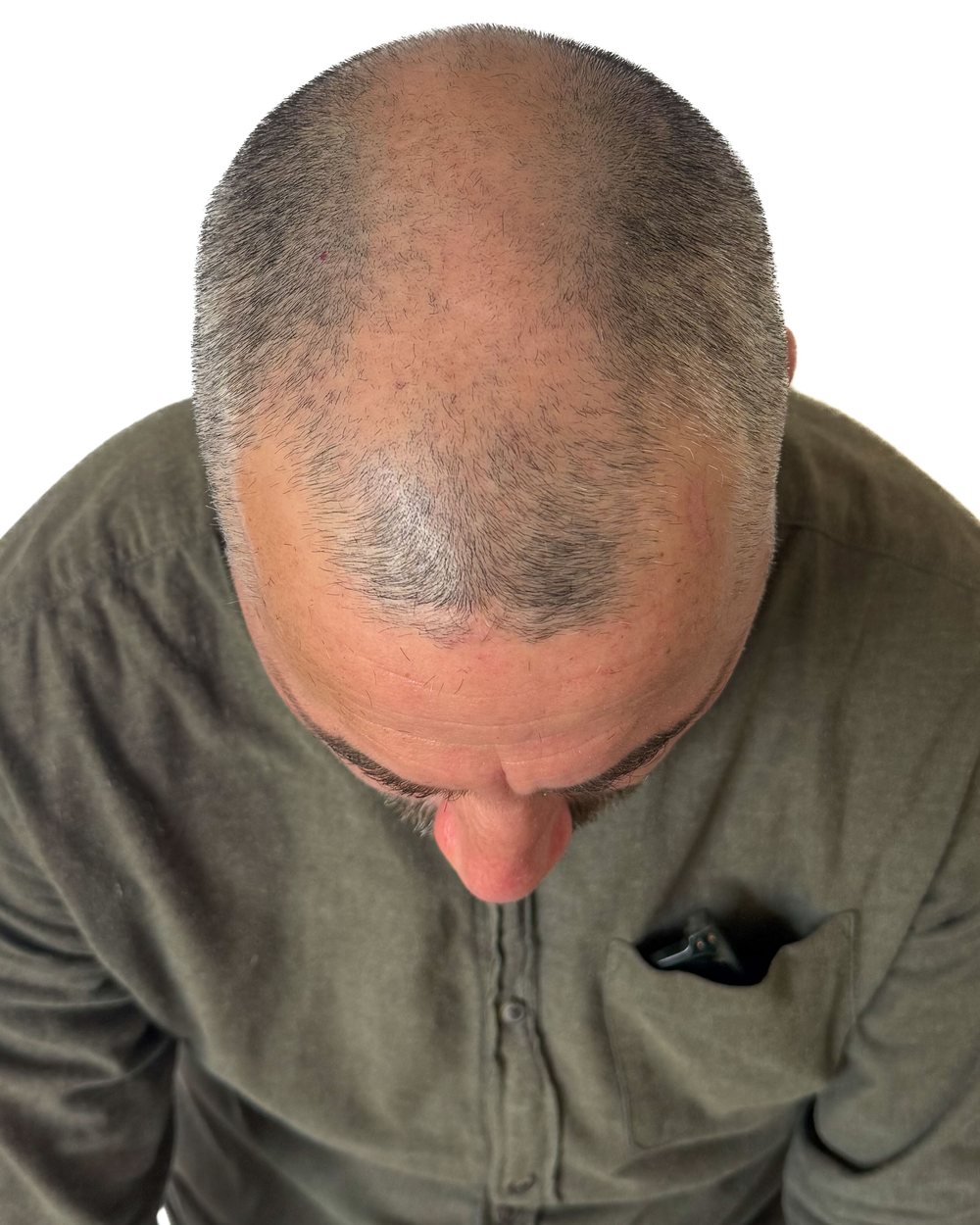 Avant micropigmentation, densité, homme, cas 2