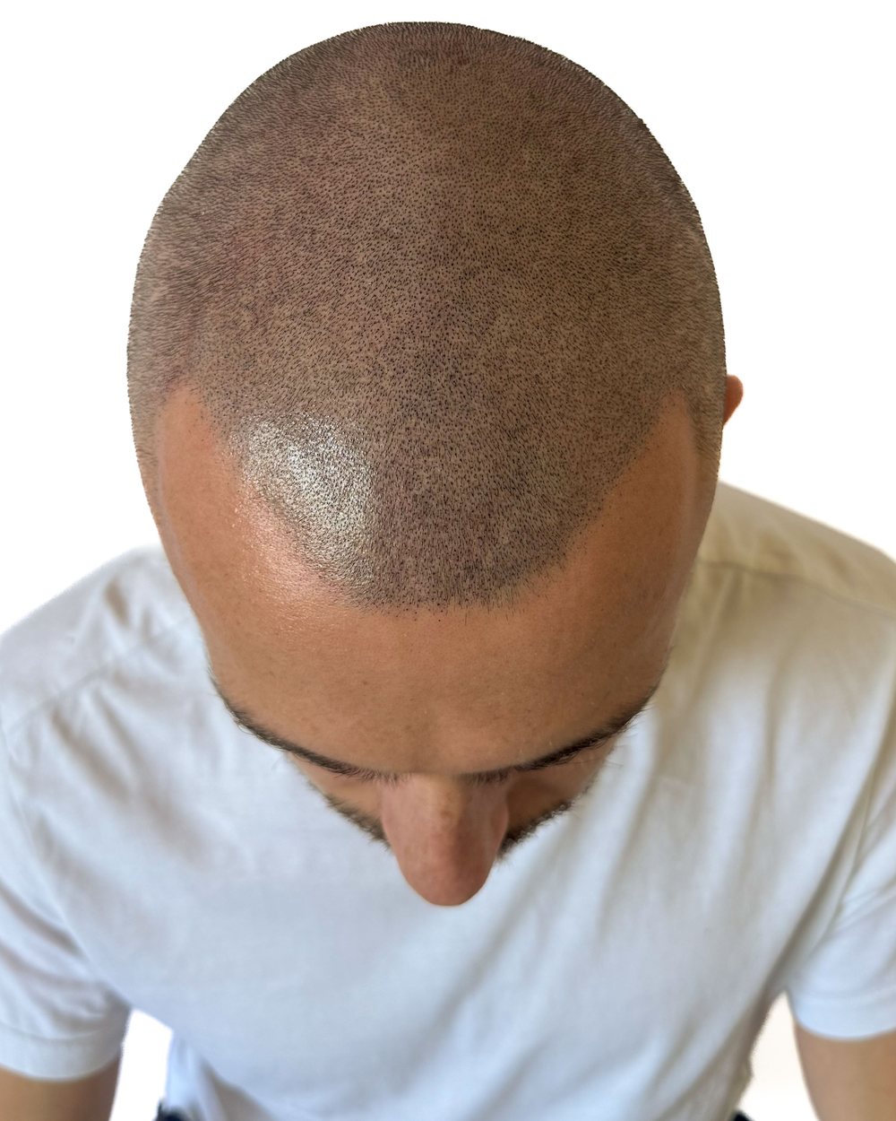 Après micropigmentation, densité, homme, cas 3