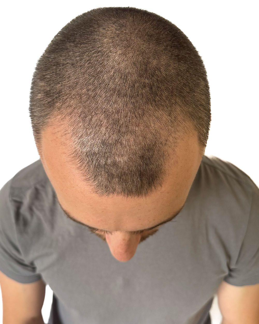 Avant micropigmentation, densité, homme, cas 3