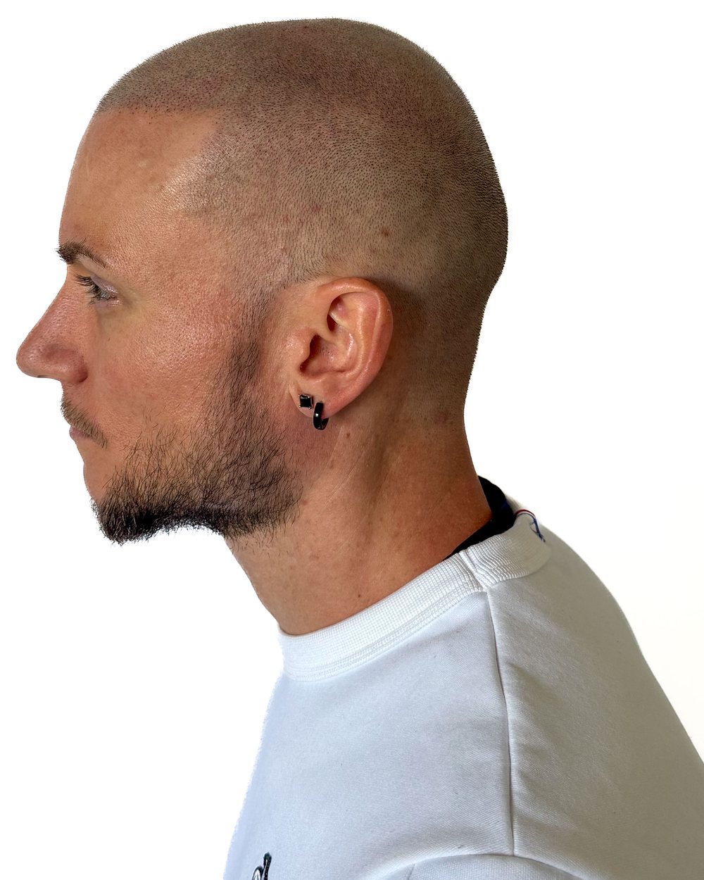 Après micropigmentation, effet rasé, vue de profil, cas 1