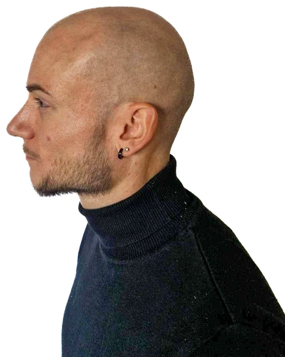 Avant micropigmentation, effet rasé, vue de profil, cas 1