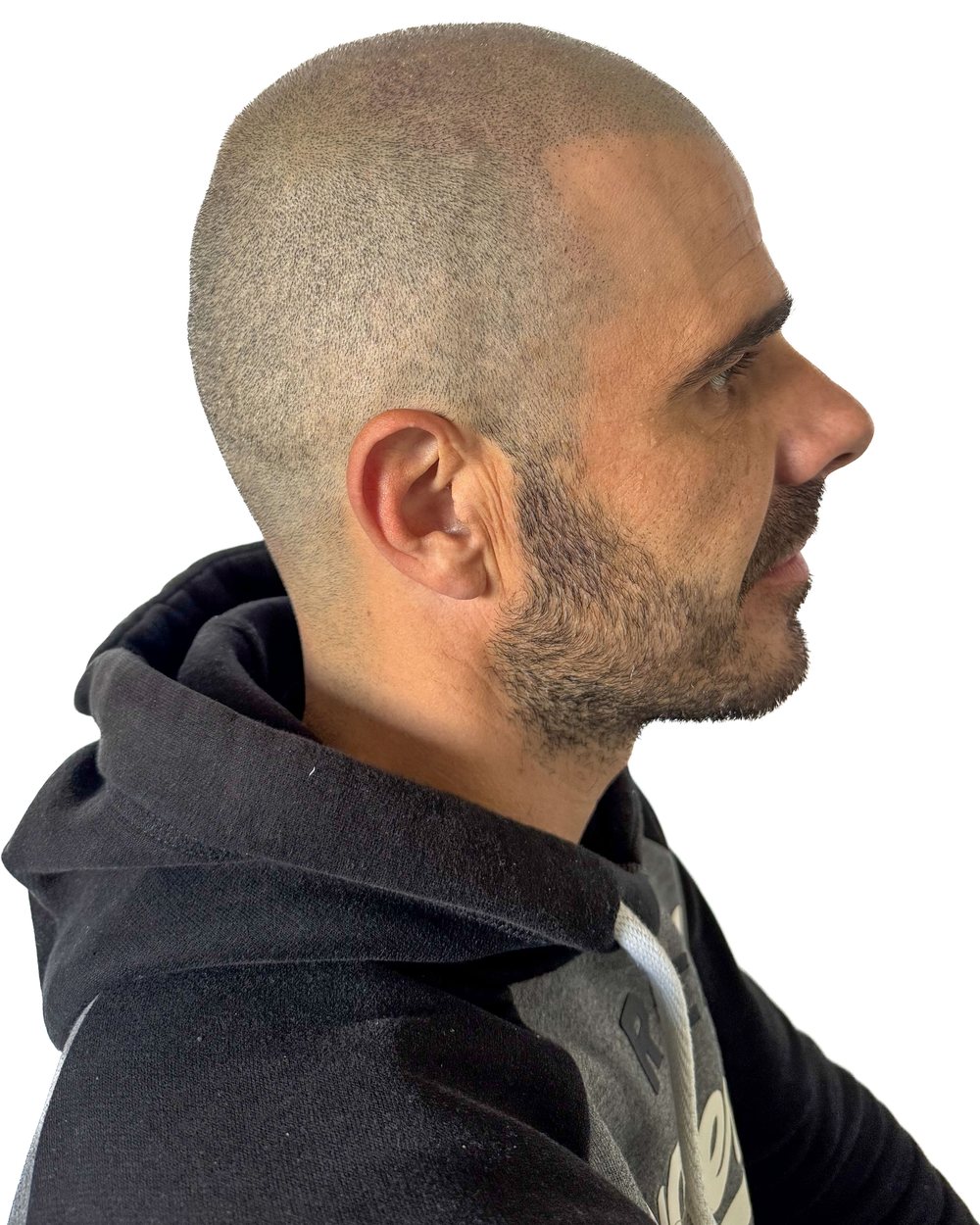 Après micropigmentation, effet rasé, vue de profil, cas 2