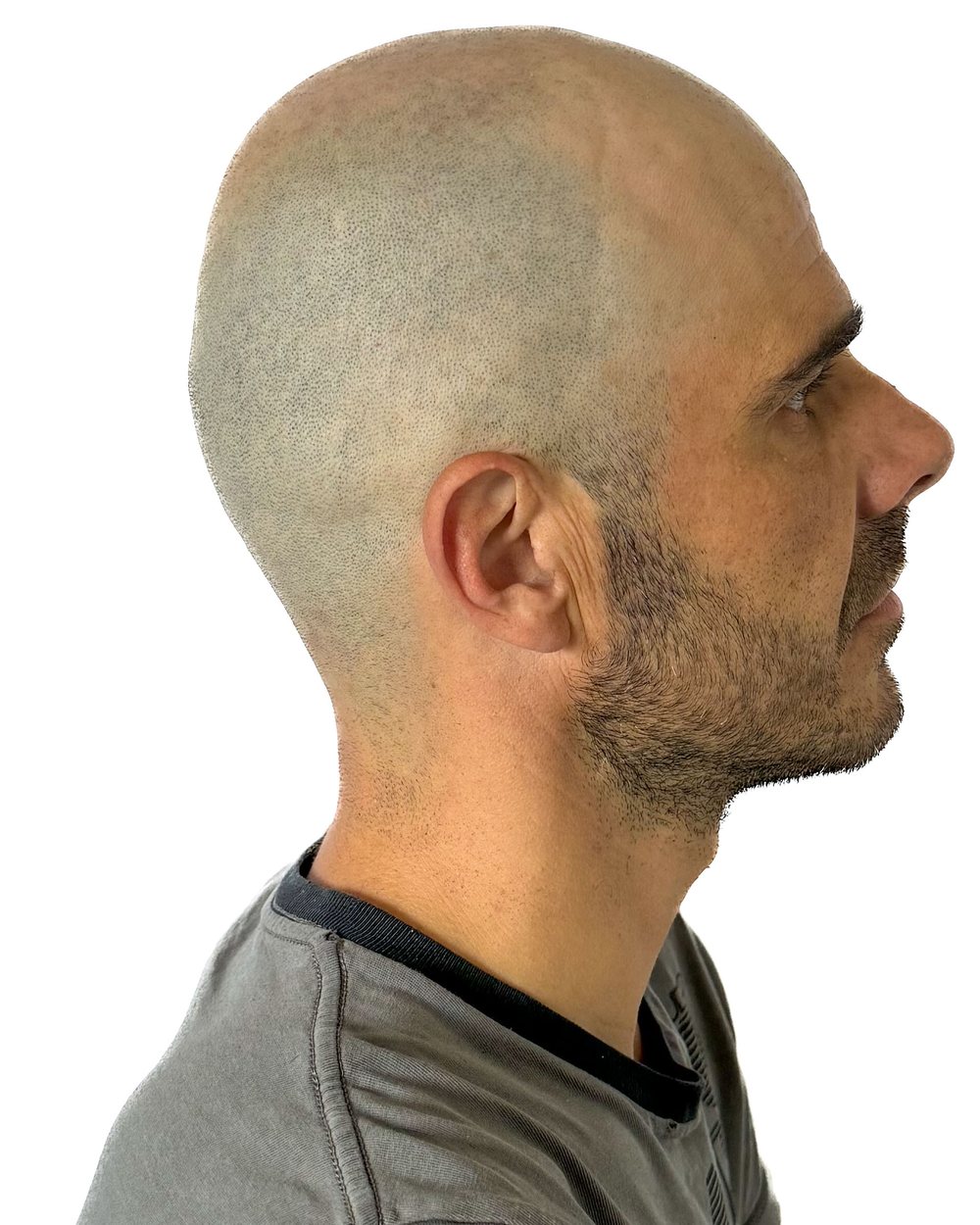Avant micropigmentation, effet rasé, vue de profil, cas 2