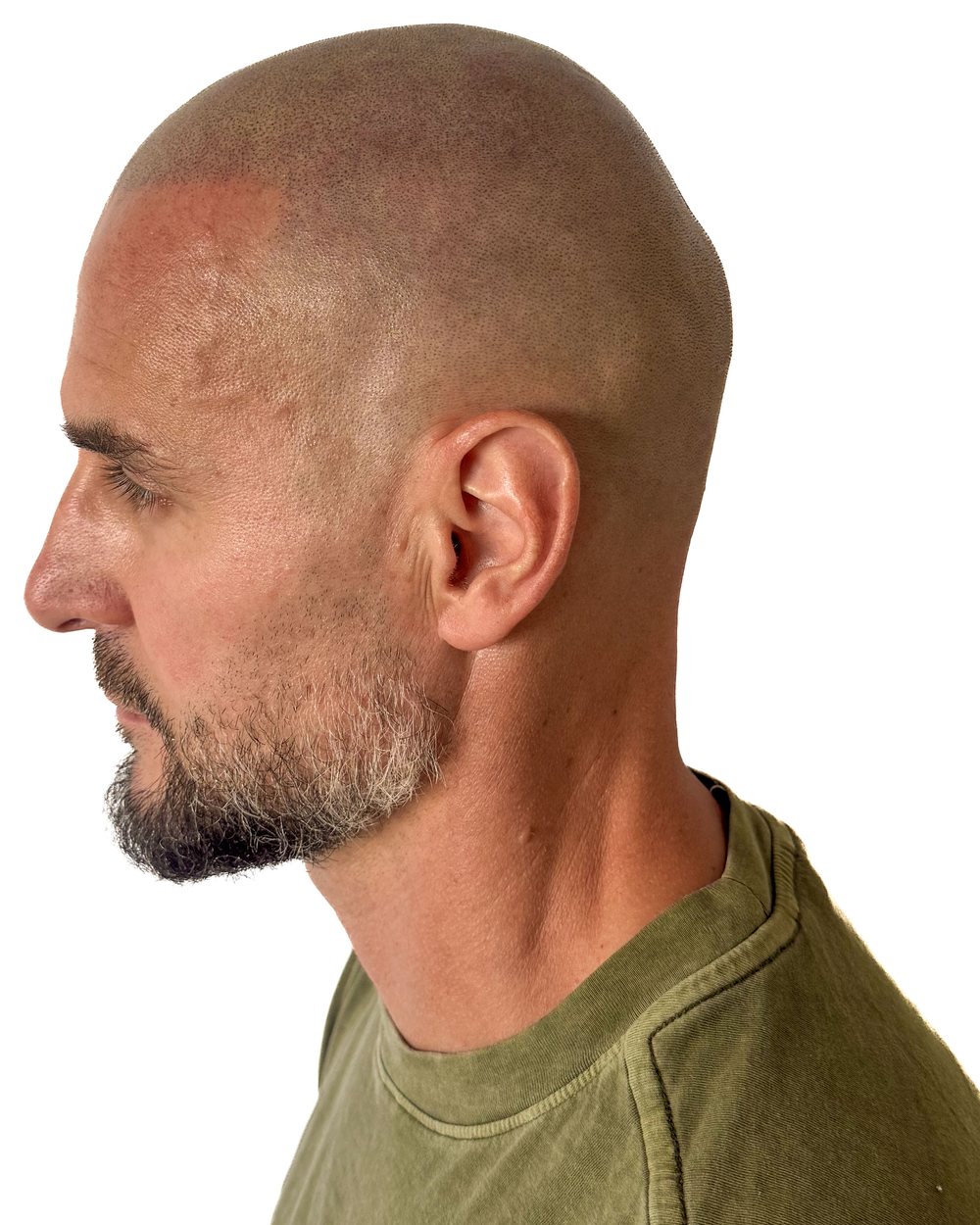 Après micropigmentation, effet rasé, vue de profil, cas 3