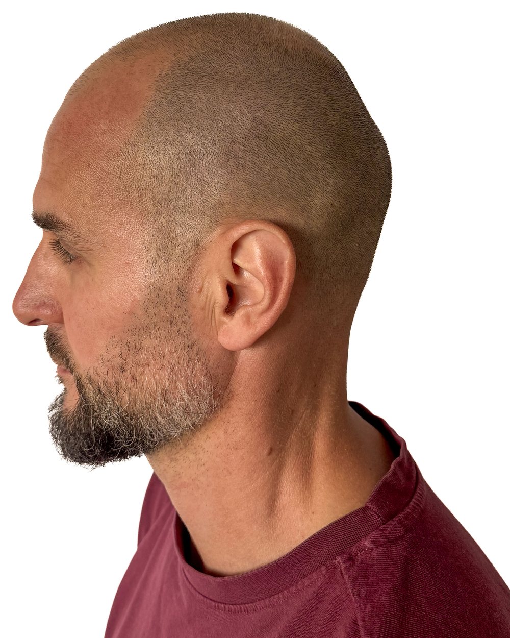 Avant micropigmentation, effet rasé, vue de profil, cas 3