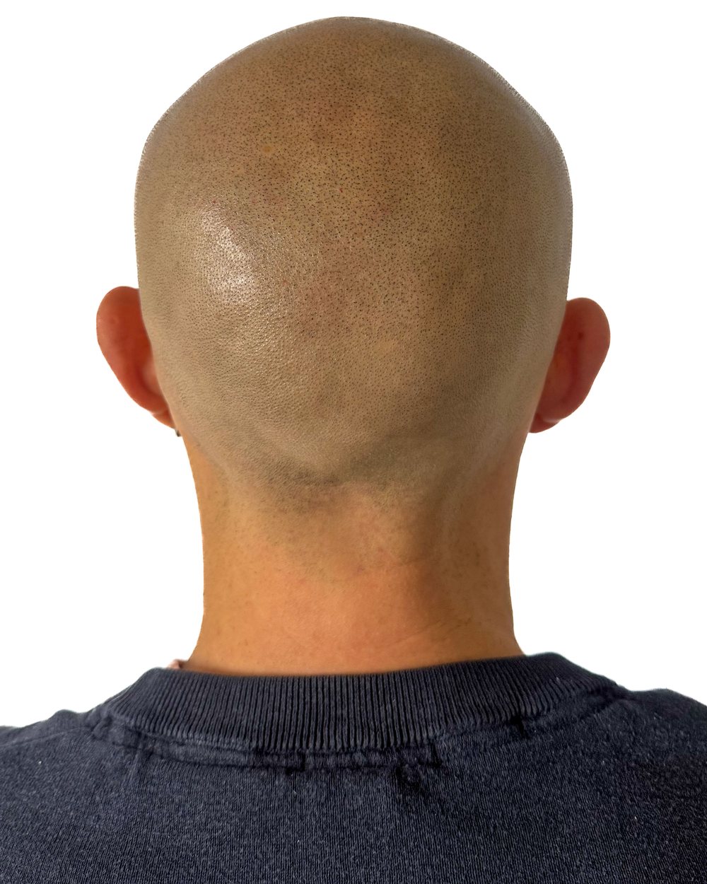 Après micropigmentation, le vertex (dessus du crâne), cas 1