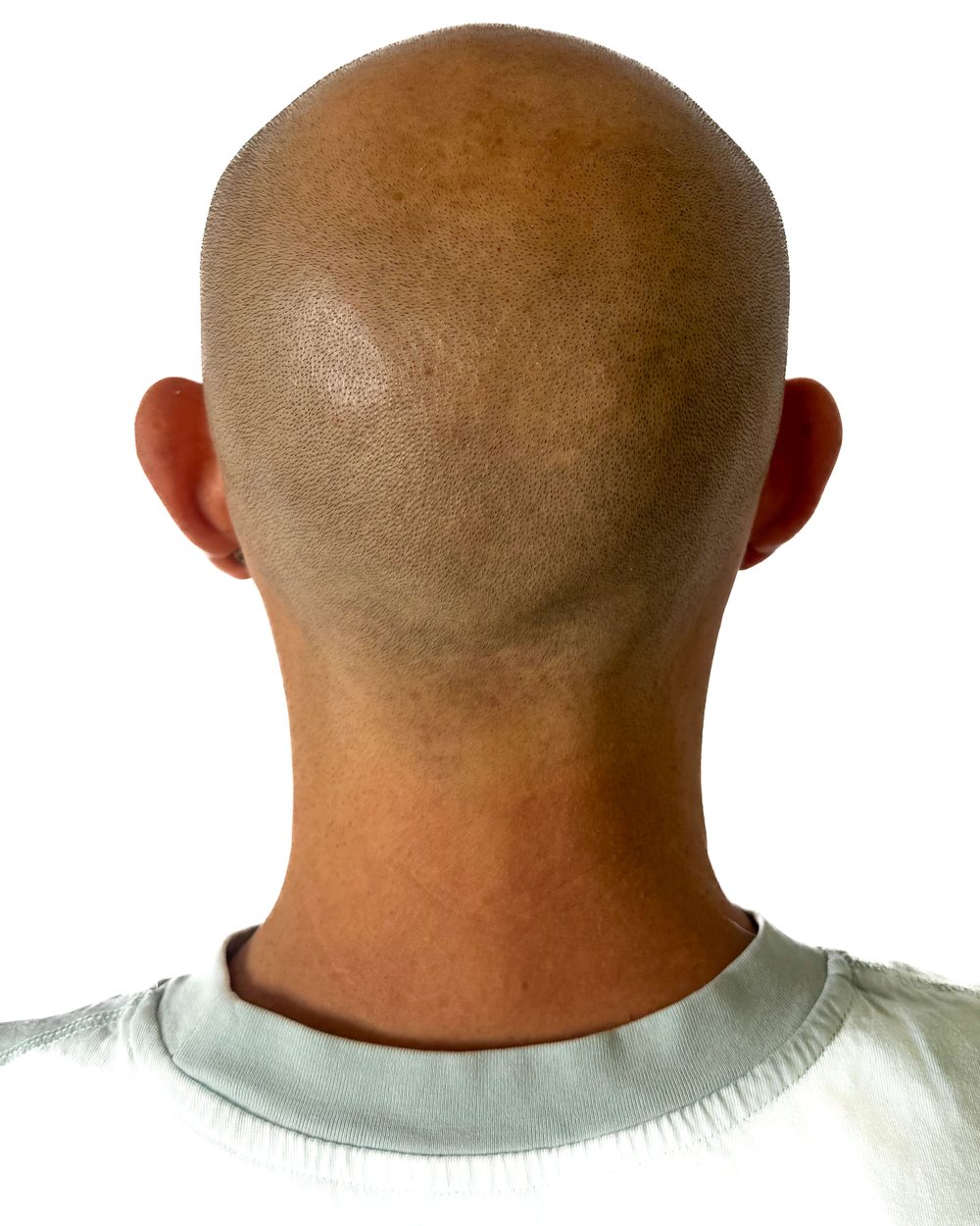 Avant micropigmentation, le vertex (dessus du crâne), cas 1