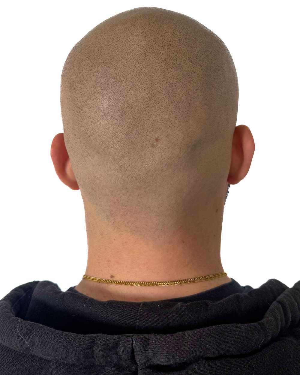 Après micropigmentation, le vertex (dessus du crâne), cas 2
