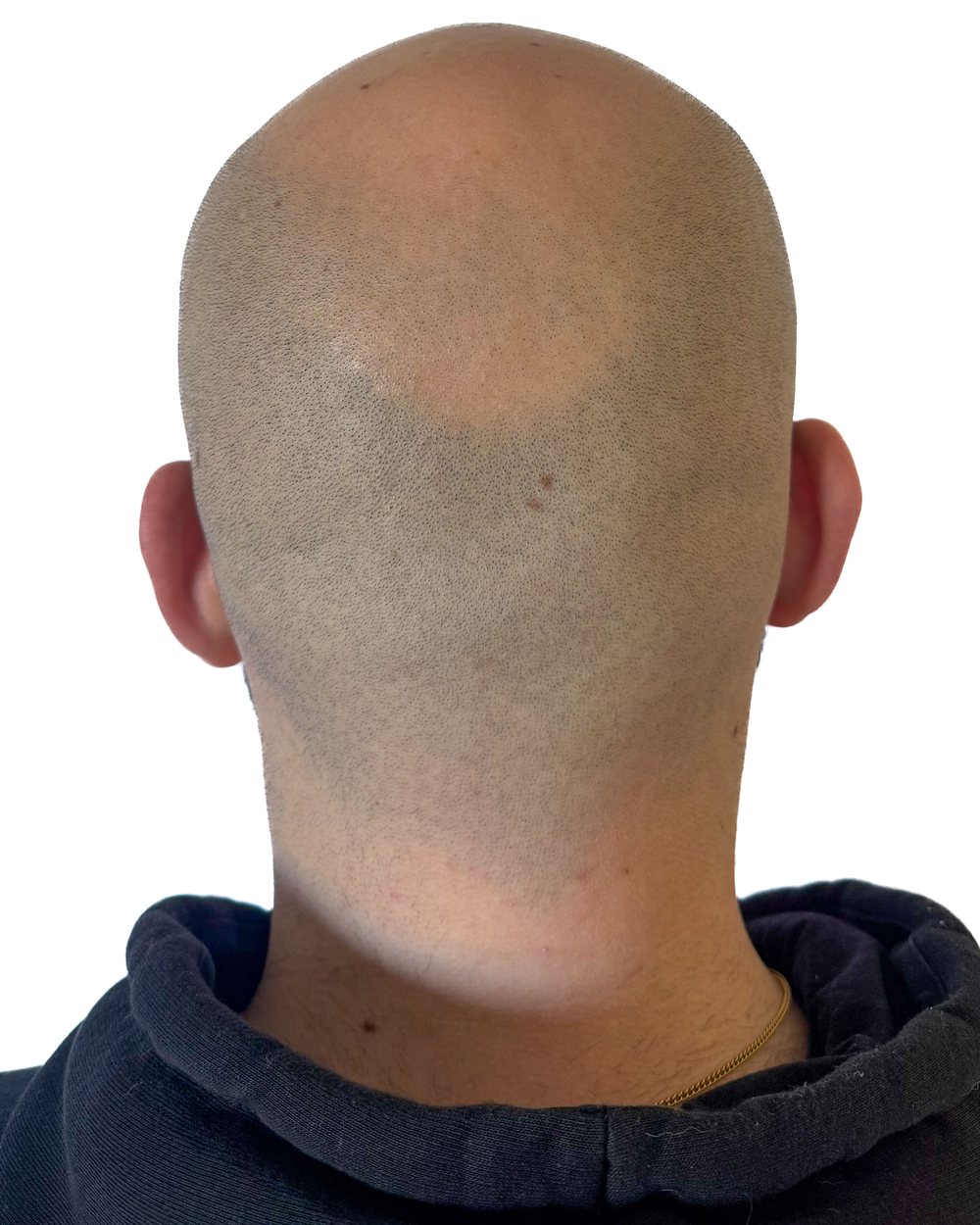 Avant micropigmentation, le vertex (dessus du crâne), cas 2