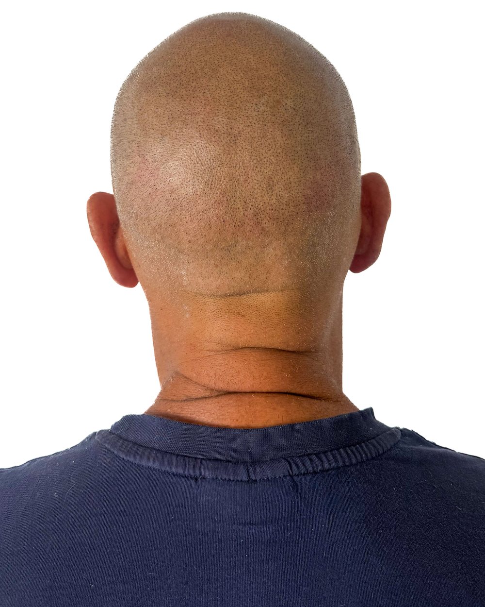 Après micropigmentation, le vertex (dessus du crâne), cas 3