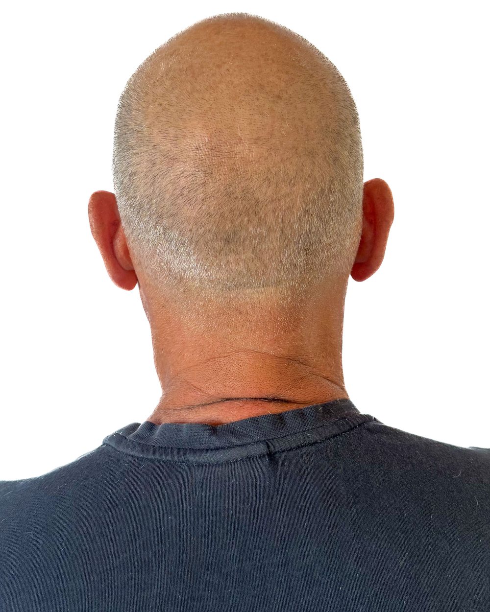 Avant micropigmentation, le vertex (dessus du crâne), cas 3