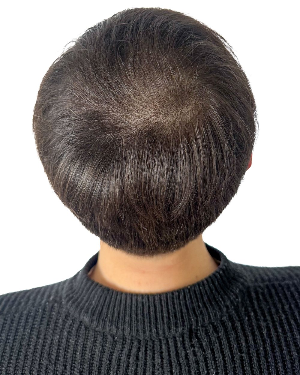 Après micropigmentation, densité au vertex, cas 1
