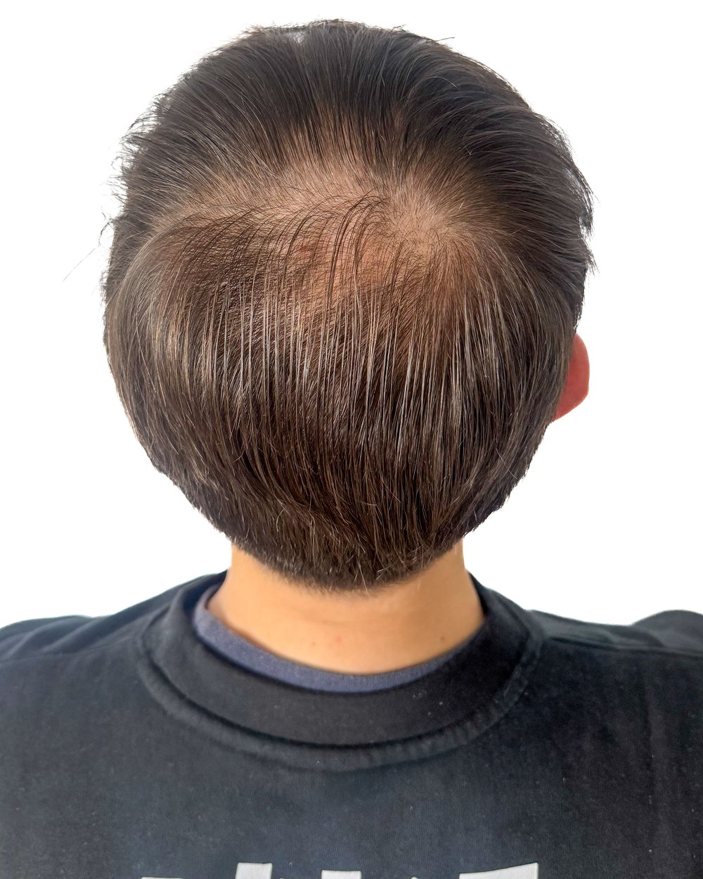 Avant micropigmentation, densité au vertex, cas 1