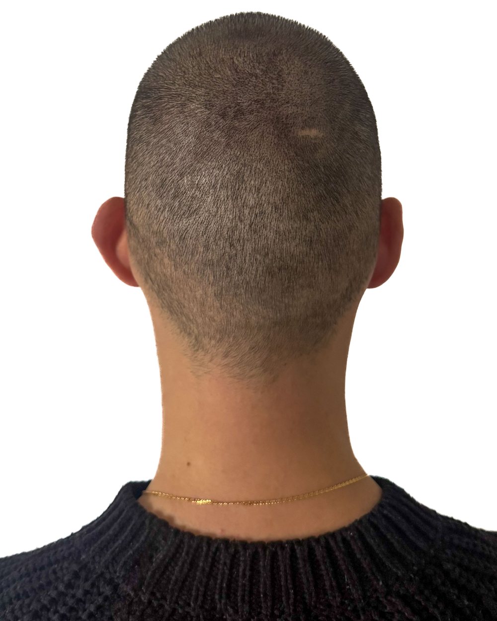 Après micropigmentation, densité au vertex, cas 2