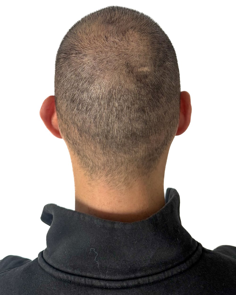 Avant micropigmentation, densité au vertex, cas 2