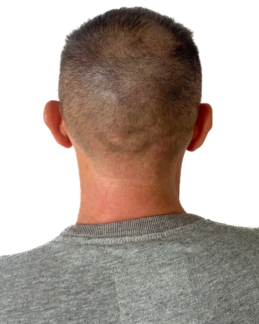 Après micropigmentation, densité au vertex, cas 3