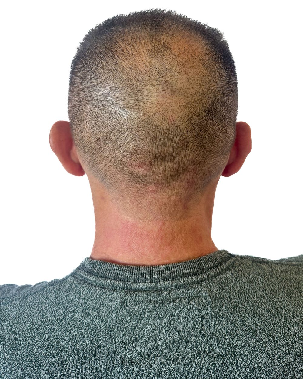Avant micropigmentation, densité au vertex, cas 3