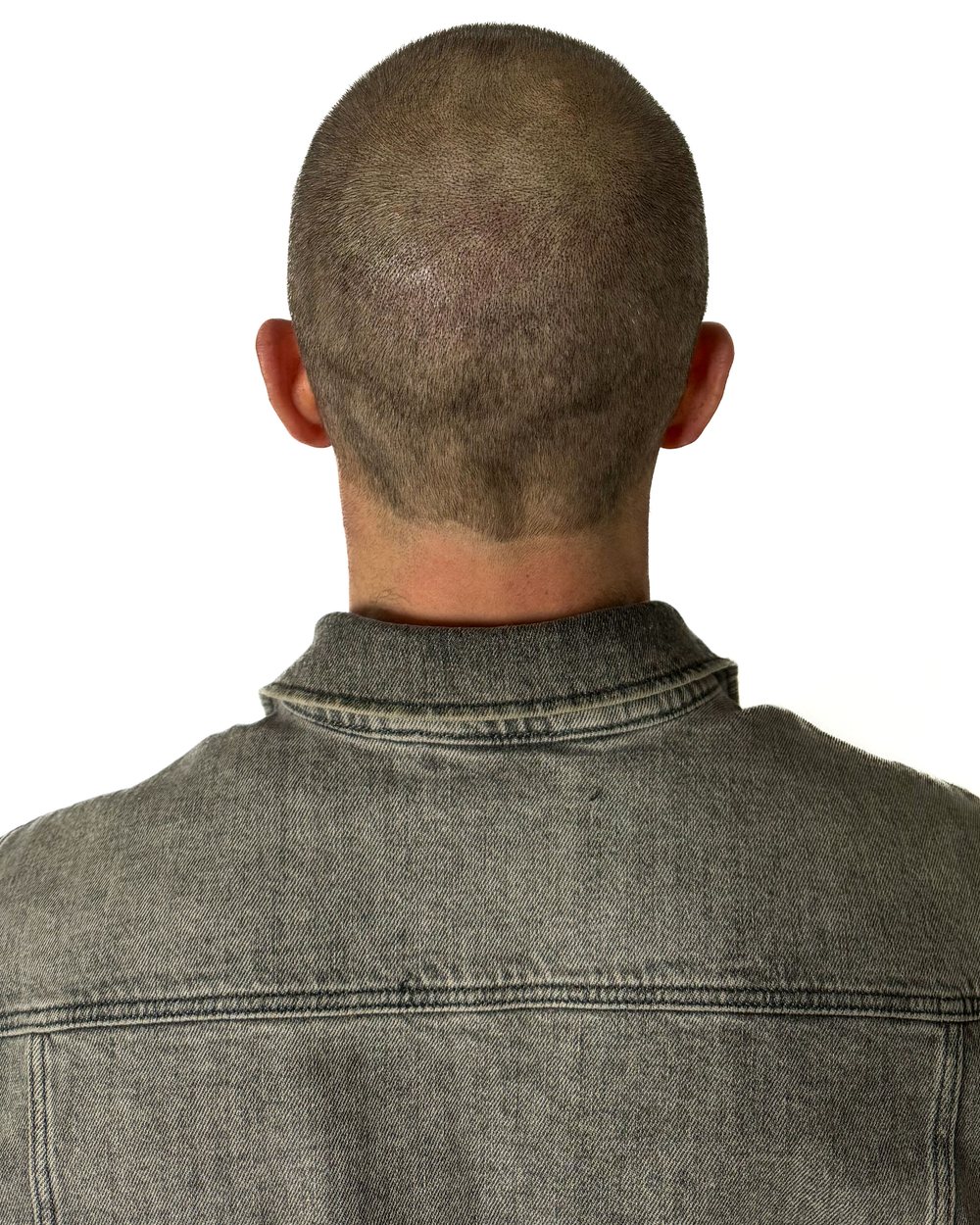 Après micropigmentation, densité au vertex, cas 4