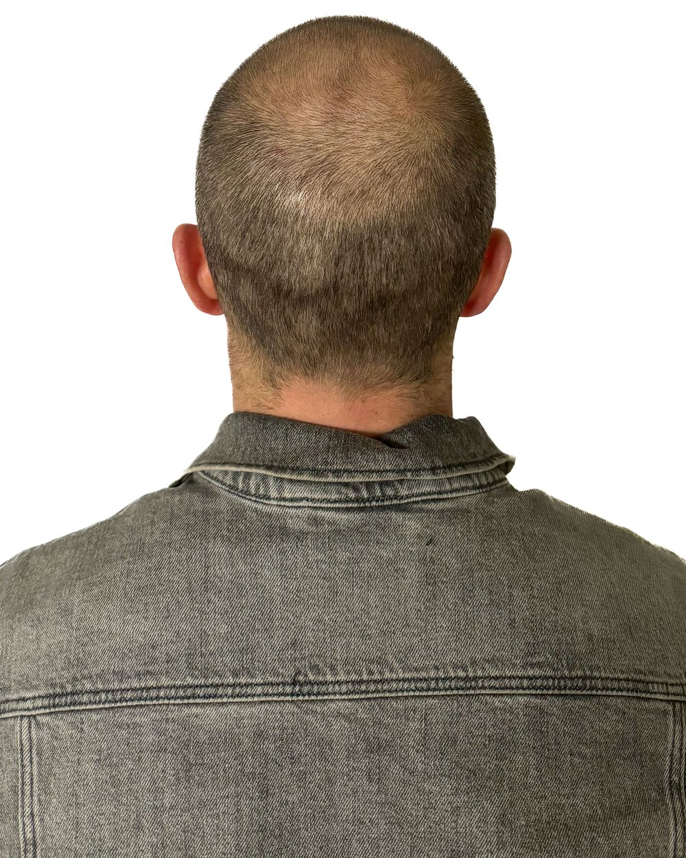 Avant micropigmentation, densité au vertex, cas 4