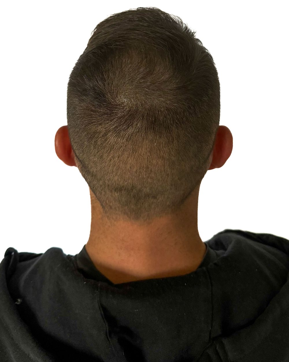 Après micropigmentation, densité au vertex, cas 5