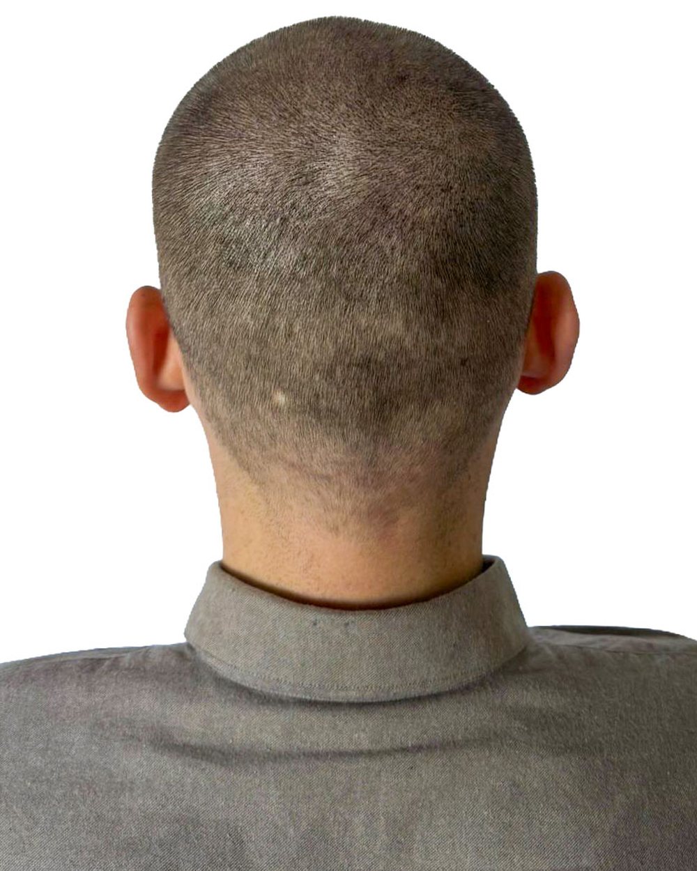 Après micropigmentation, densité au vertex, cas 6