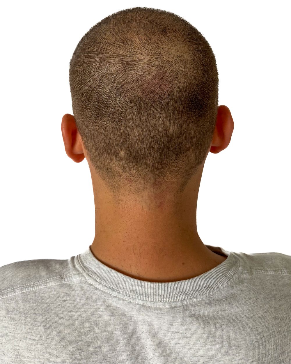 Avant micropigmentation, densité au vertex, cas 6